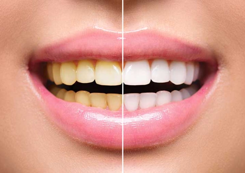 Teeth Whitening Methods and Risks